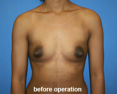 plastic-surgery-breast-augmentation